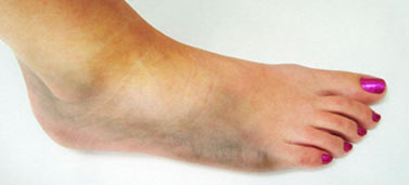 -diyabet ayak--117.jpg